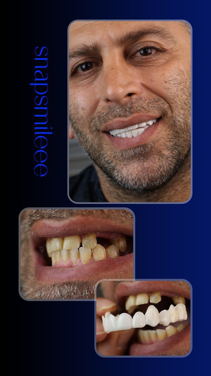  لمینت دندان دو فک اصلی برای خرابی 2 دندان vision دکترفروش